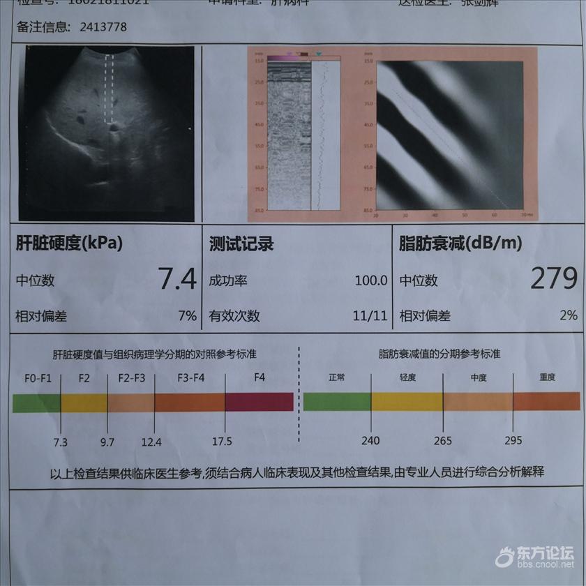 为何要做肝脏瞬时弹性硬度检查[复制]