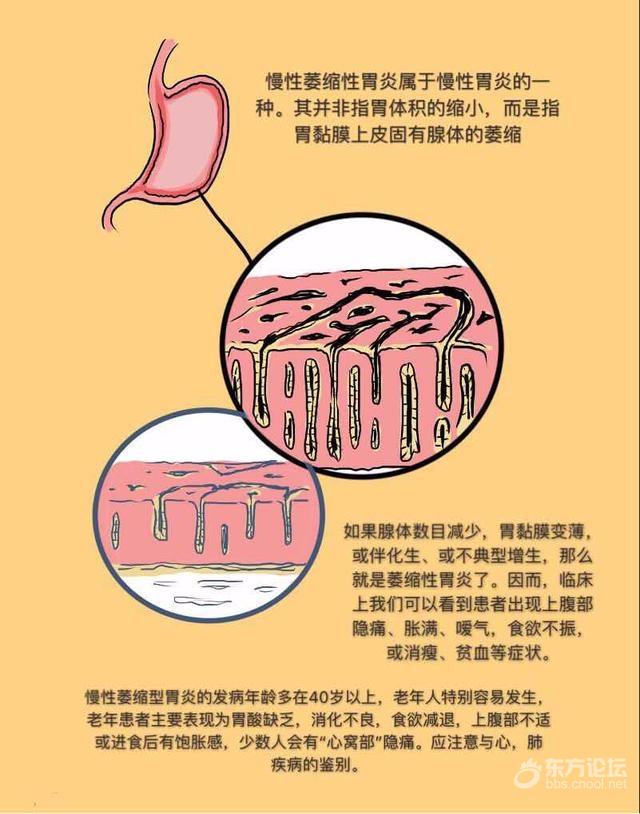 40岁后出现了这些症状,当心是慢性萎缩性胃炎犯了