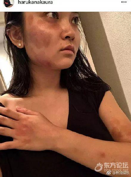 最新!知名男星承认对女友施暴:让你们失望了!其女友晒多张受伤照...