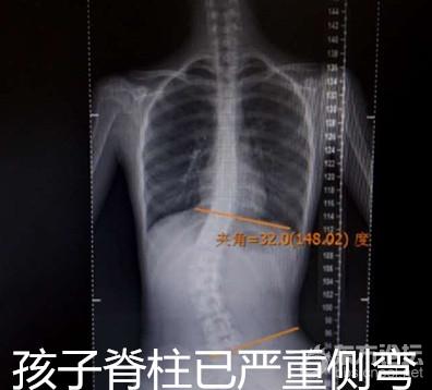 宁海女生面临20万元大手术,之前学校体检却正常