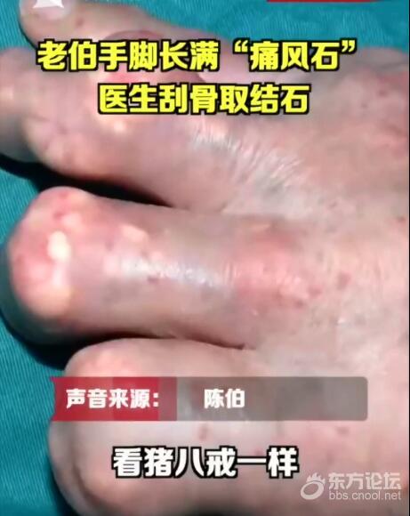 把海鲜当饭吃!老伯手脚长满“痛风石” 医生刮骨清除