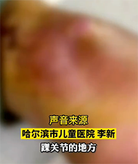 皮肤红肿发紫!男孩被蚊子叮了一下差点残疾