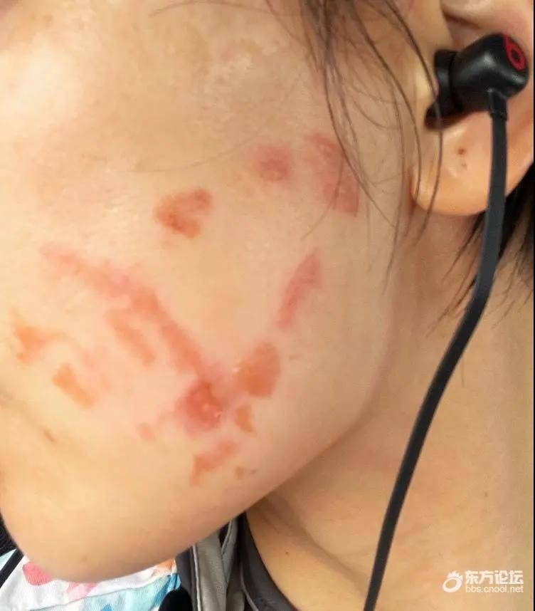 震怒!花10000+在宁波羞和做医美,满脸起水泡,医院鉴定为二度烫伤