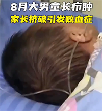 家长挤了一个小脓包8个月宝宝住进ICU