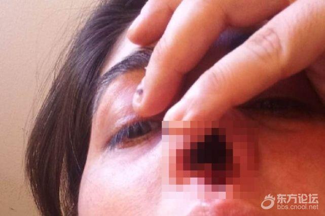 阿根廷一女子新冠鼻拭子核酸检测引发恐怖感染 鼻软骨全化“2洞变1洞”